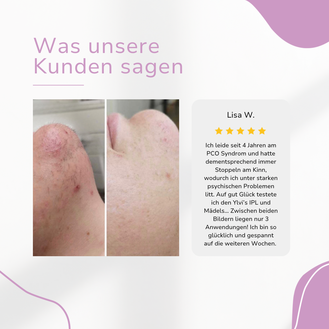 Venzani Lumi IPL Hair Remover I Den ledende laser hårfjerning for hjemmet